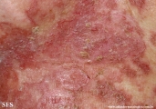 pemphigus foliaceus