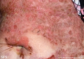 pemphigus foliaceus