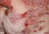 pemphigus foliaceus