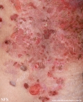 pemphigus foliaceus