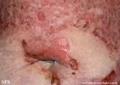 pemphigus foliaceus