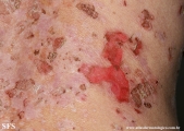 pemphigus foliaceus
