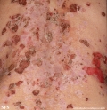 pemphigus foliaceus
