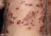 pemphigus foliaceus