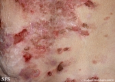 pemphigus foliaceus