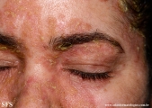 pemphigus foliaceus