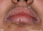 pemphigus foliaceus