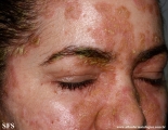 pemphigus foliaceus