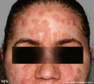 pemphigus foliaceus