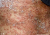 pemphigus foliaceus