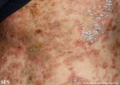 pemphigus foliaceus