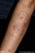pemphigus foliaceus