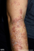 pemphigus foliaceus