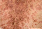pemphigus foliaceus