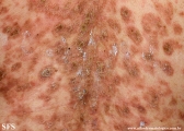 pemphigus foliaceus
