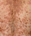 pemphigus foliaceus