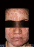 pemphigus foliaceus