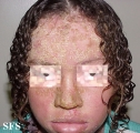 pemphigus foliaceus