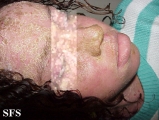 pemphigus foliaceus