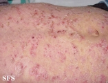 pemphigus foliaceus