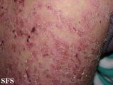 pemphigus foliaceus