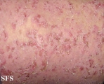 pemphigus foliaceus