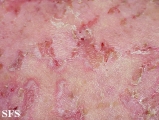 pemphigus foliaceus