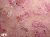 pemphigus foliaceus