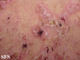 pemphigus foliaceus