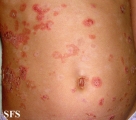 pemphigus foliaceus
