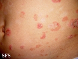 pemphigus foliaceus
