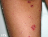 pemphigus foliaceus