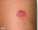 pemphigus foliaceus