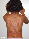 pemphigus foliaceus