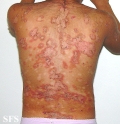pemphigus foliaceus