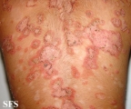 pemphigus foliaceus
