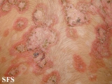 pemphigus foliaceus