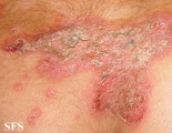 pemphigus foliaceus