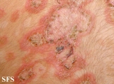 pemphigus foliaceus