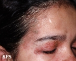 pemphigus foliaceus