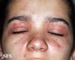 pemphigus foliaceus