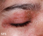 pemphigus foliaceus