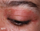 pemphigus foliaceus