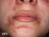 pemphigus foliaceus
