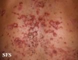pemphigus foliaceus