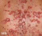 pemphigus foliaceus
