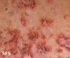 pemphigus foliaceus