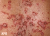 pemphigus foliaceus