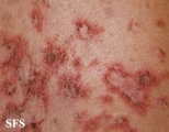 pemphigus foliaceus