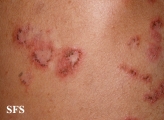 pemphigus foliaceus